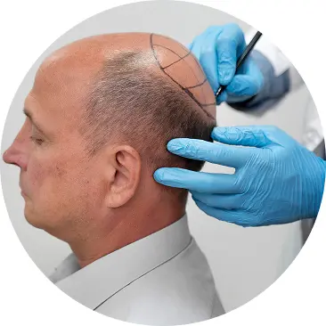 Hair Transplant